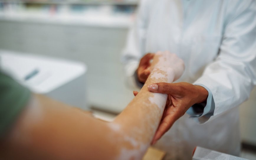 Cover Image for Clinuvel Pharmaceuticals reaches patient recruitment milestone ahead of Phase III Scenesse vitiligo trial