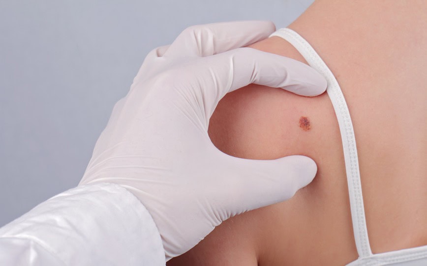 Cover Image for Invion advances skin cancer treatment with positive safety data for INV043 in Phase I/II trial