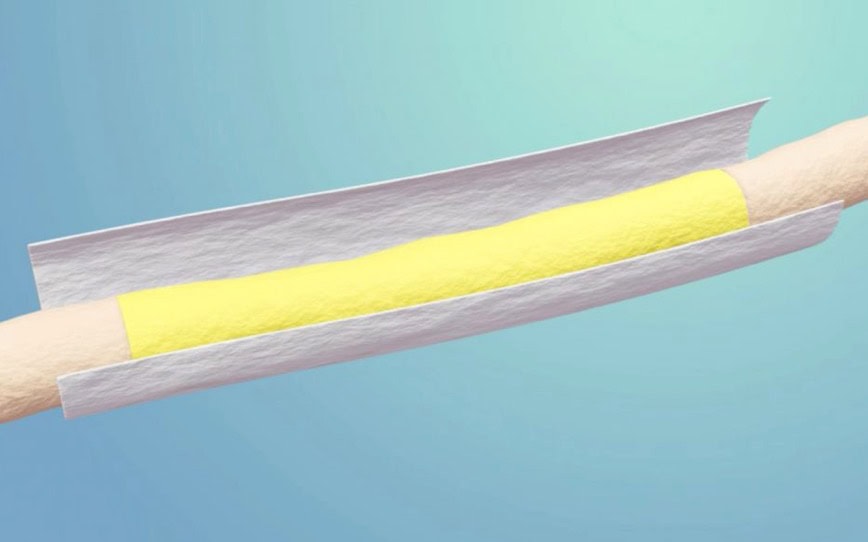 Cover Image for ReNerve study shows major patient outcome benefits of NervAlign nerve cuff